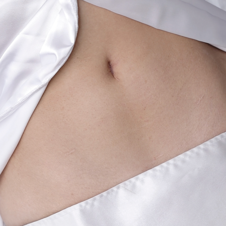 Laparoscopia sin cicatriz